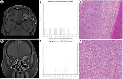 Metagenomic Next-Generation Sequencing of Cerebrospinal Fluid for the Diagnosis of Cerebral Aspergillosis